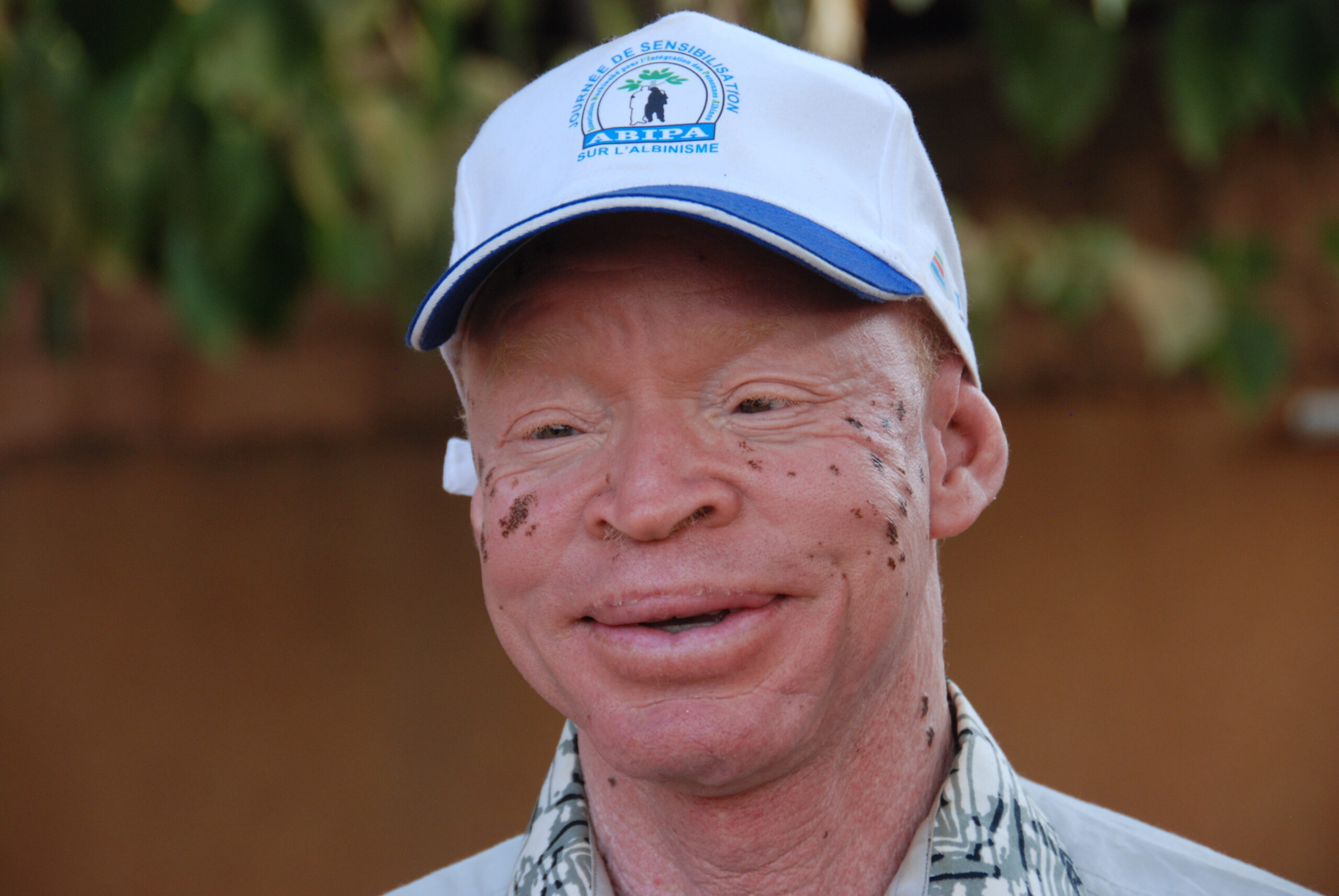 Fabere zet zich in voor andere mensen met albinisme